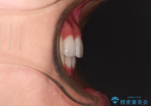 飛び出した前歯と黄ばんだ歯 ホワイトニングしながらマウスピース矯正の治療後