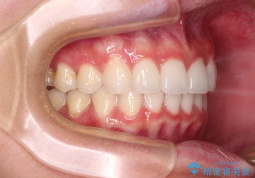 飛び出した前歯と黄ばんだ歯 ホワイトニングしながらマウスピース矯正の治療後