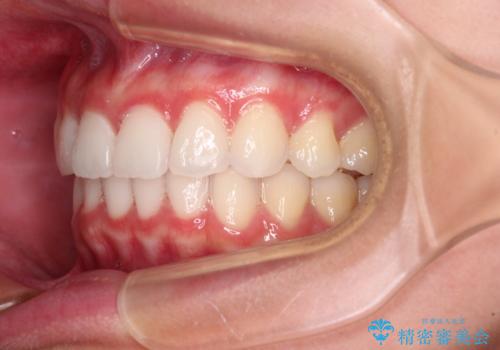 飛び出した前歯と黄ばんだ歯 ホワイトニングしながらマウスピース矯正の治療後