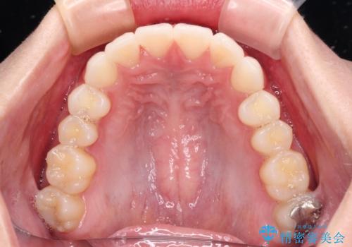 飛び出した前歯と黄ばんだ歯 ホワイトニングしながらマウスピース矯正の治療後