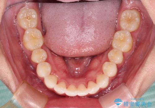 飛び出した前歯と黄ばんだ歯 ホワイトニングしながらマウスピース矯正の治療後