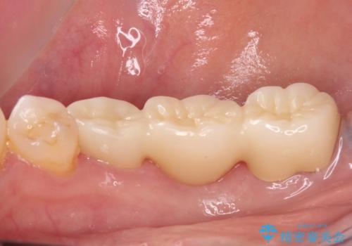インプラントしかないと言われた 奥歯のオールセラミックブリッジの治療後