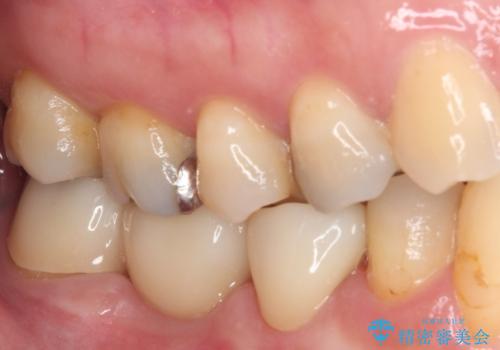 インプラントしかないと言われた 奥歯のオールセラミックブリッジの治療後