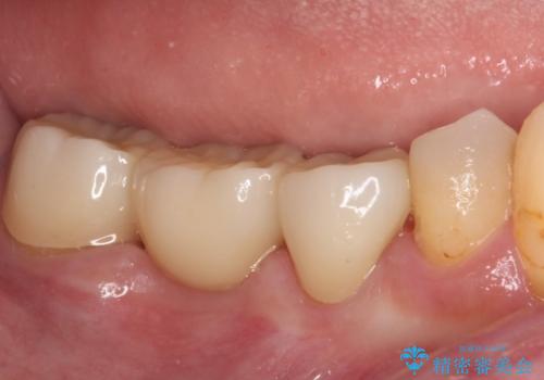 インプラントしかないと言われた 奥歯のオールセラミックブリッジの治療後