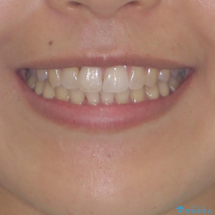 前歯のデコボコをインビザラインでスッキリと仕上げるの治療後(顔貌)