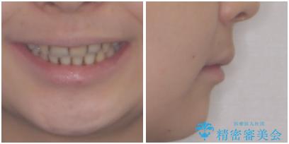 出っ歯を治したい ワイヤー装置による抜歯矯正の治療後(顔貌)