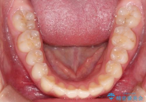 インビザラインによる出っ歯の非抜歯矯正の治療前
