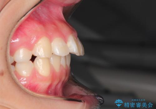 インビザラインによる出っ歯の非抜歯矯正の治療前