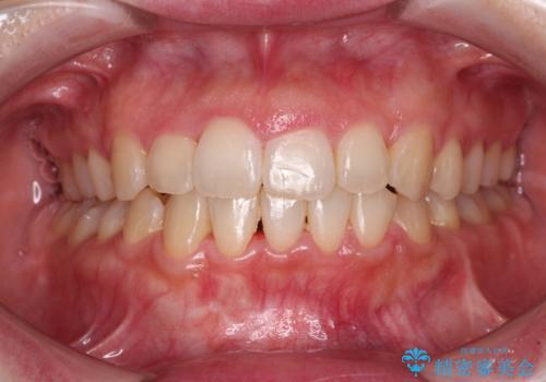 変則的な抜歯矯正　八重歯を抜いてしまった人のワイヤー矯正の症例 治療後