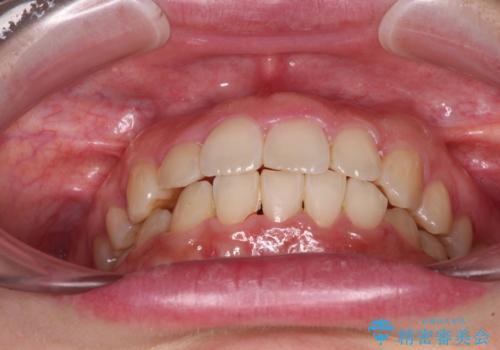 変則的な抜歯矯正 八重歯を抜いてしまった人のワイヤー矯正の治療後