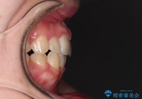 変則的な抜歯矯正 八重歯を抜いてしまった人のワイヤー矯正の治療後