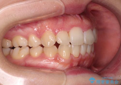 変則的な抜歯矯正 八重歯を抜いてしまった人のワイヤー矯正の治療後