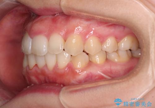 変則的な抜歯矯正 八重歯を抜いてしまった人のワイヤー矯正の治療後