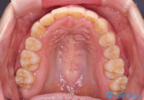 変則的な抜歯矯正　八重歯を抜いてしまった人のワイヤー矯正の治療後