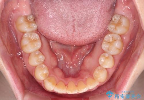 変則的な抜歯矯正　八重歯を抜いてしまった人のワイヤー矯正の治療後