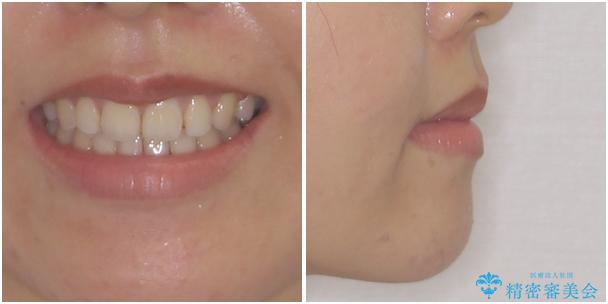 閉じにくい唇を抜歯矯正で閉じやすく 目だたないワイヤー矯正の治療後(顔貌)