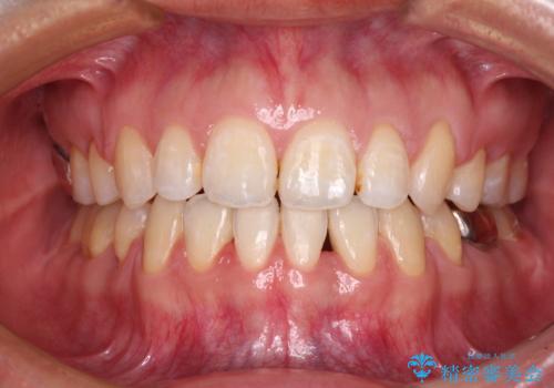 閉じにくい唇を抜歯矯正で閉じやすく 目だたないワイヤー矯正