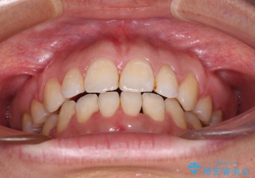 閉じにくい唇を抜歯矯正で閉じやすく 目だたないワイヤー矯正の治療後