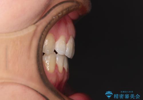 閉じにくい唇を抜歯矯正で閉じやすく 目だたないワイヤー矯正の治療後