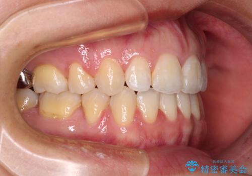 閉じにくい唇を抜歯矯正で閉じやすく 目だたないワイヤー矯正の治療後