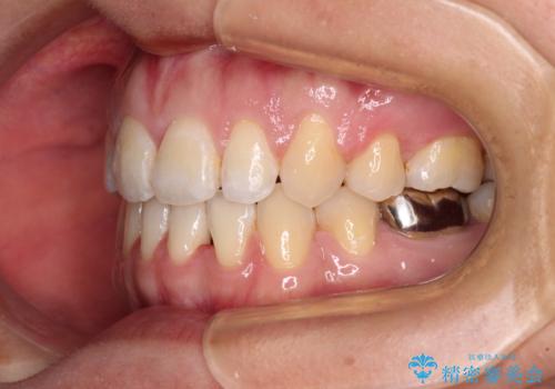 閉じにくい唇を抜歯矯正で閉じやすく 目だたないワイヤー矯正の治療後