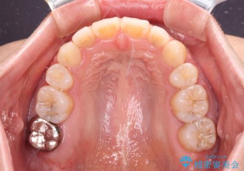 閉じにくい唇を抜歯矯正で閉じやすく 目だたないワイヤー矯正の治療後
