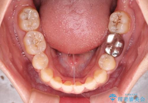 閉じにくい唇を抜歯矯正で閉じやすく 目だたないワイヤー矯正の治療後