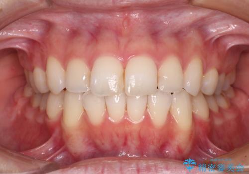 【モニター】前歯のデコボコをインビザラインできれいに整えるの症例 治療後