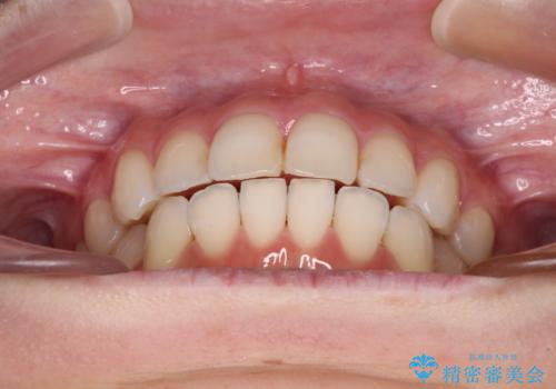 【モニター】前歯のデコボコをインビザラインできれいに整えるの治療後