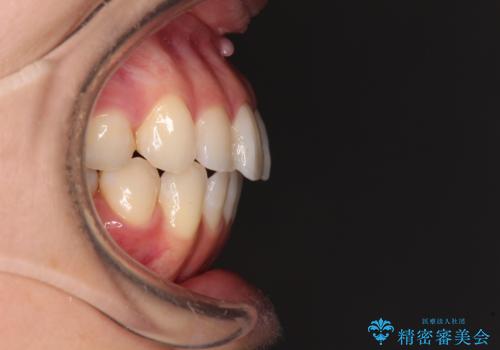 【モニター】前歯のデコボコをインビザラインできれいに整えるの治療後