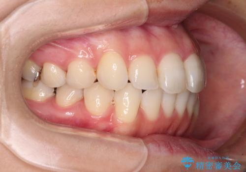 【モニター】前歯のデコボコをインビザラインできれいに整えるの治療後