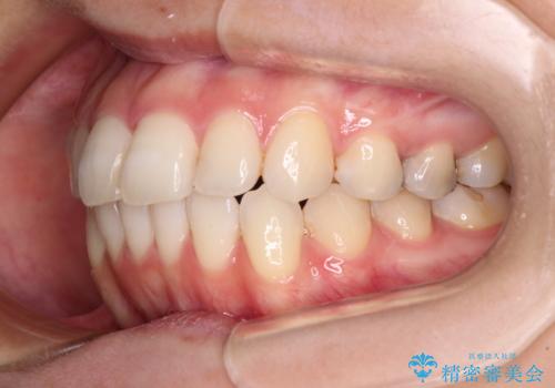 【モニター】前歯のデコボコをインビザラインできれいに整えるの治療後