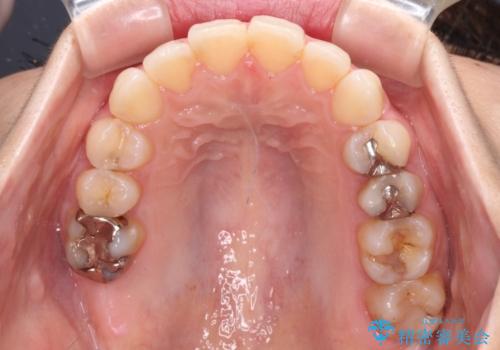 【モニター】前歯のデコボコをインビザラインできれいに整えるの治療後