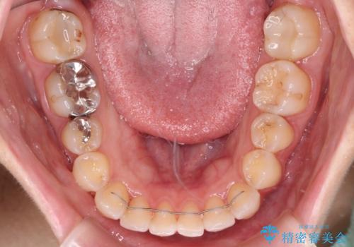 【モニター】前歯のデコボコをインビザラインできれいに整えるの治療後