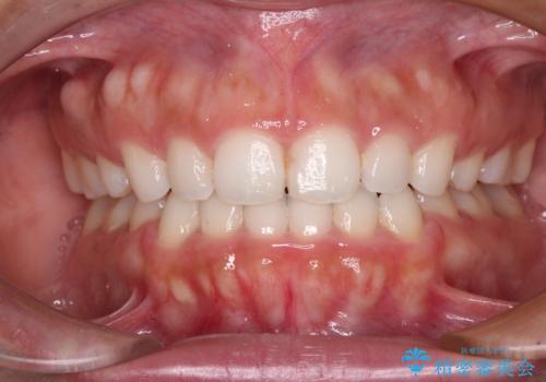 目立たない装置で横顔のシルエットを改善 ハーフリンガルでの抜歯矯正の症例 治療後