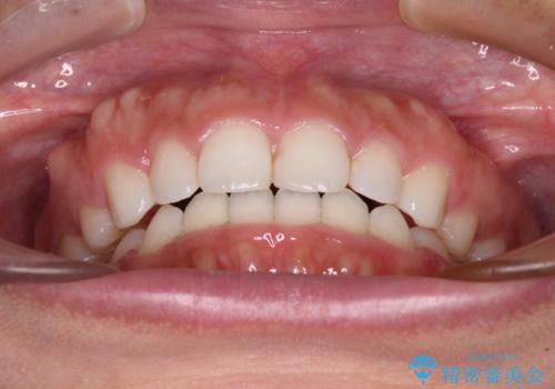 目立たない装置で横顔のシルエットを改善 ハーフリンガルでの抜歯矯正の治療後