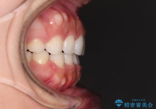 目立たない装置で横顔のシルエットを改善 ハーフリンガルでの抜歯矯正の治療後