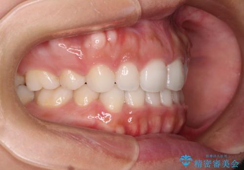 目立たない装置で横顔のシルエットを改善 ハーフリンガルでの抜歯矯正の治療後