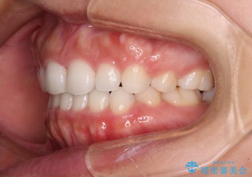 目立たない装置で横顔のシルエットを改善 ハーフリンガルでの抜歯矯正の治療後