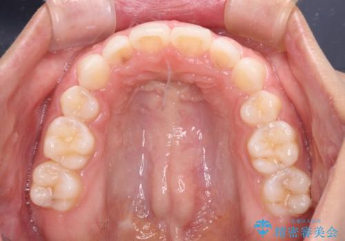 目立たない装置で横顔のシルエットを改善 ハーフリンガルでの抜歯矯正の治療後