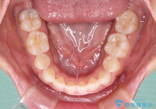 目立たない装置で横顔のシルエットを改善 ハーフリンガルでの抜歯矯正の治療後