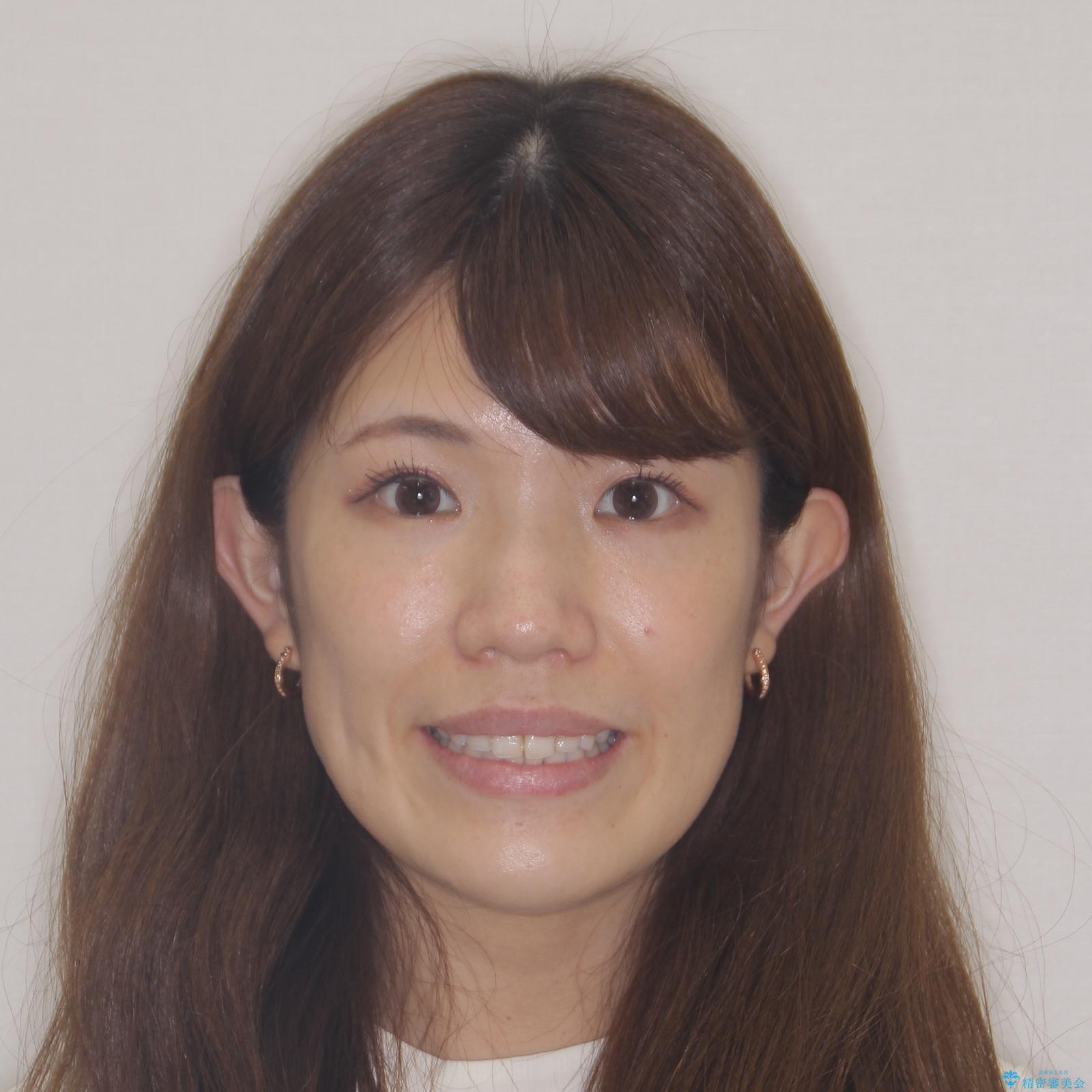 【モニター】前歯のデコボコをインビザラインできれいに整えるの治療後(顔貌)