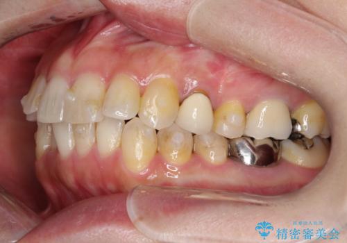 大人の目立たない矯正 インビザラインの治療中