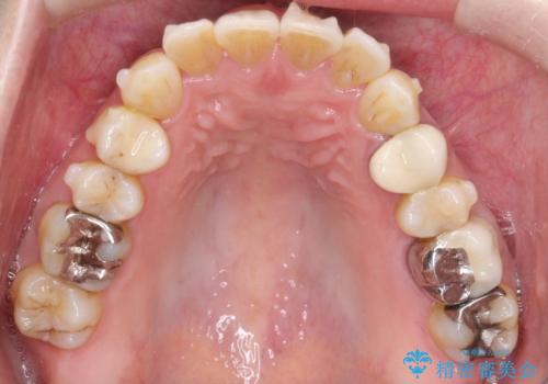 大人の目立たない矯正 インビザラインの治療中