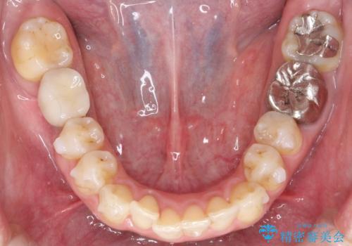 大人の目立たない矯正 インビザラインの治療中