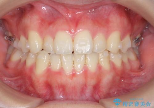 マウスピース矯正で前歯のガタつきを改善の治療中