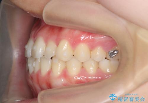 マウスピース矯正で前歯のガタつきを改善の治療中