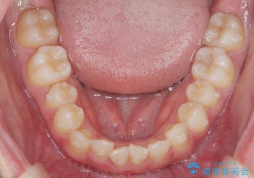 マウスピース矯正で前歯のガタつきを改善の治療中
