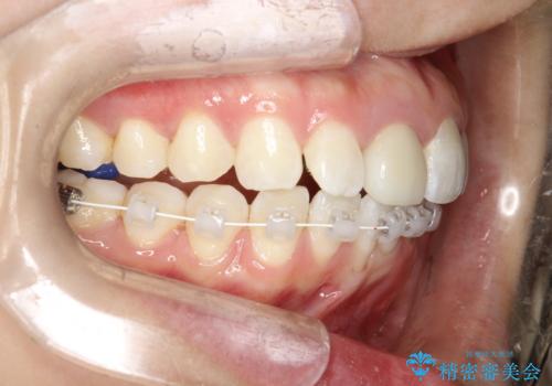 後戻りした歯並びをきれいにしたいの治療中