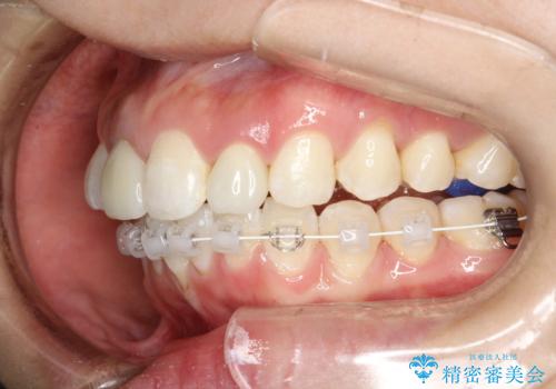 後戻りした歯並びをきれいにしたいの治療中